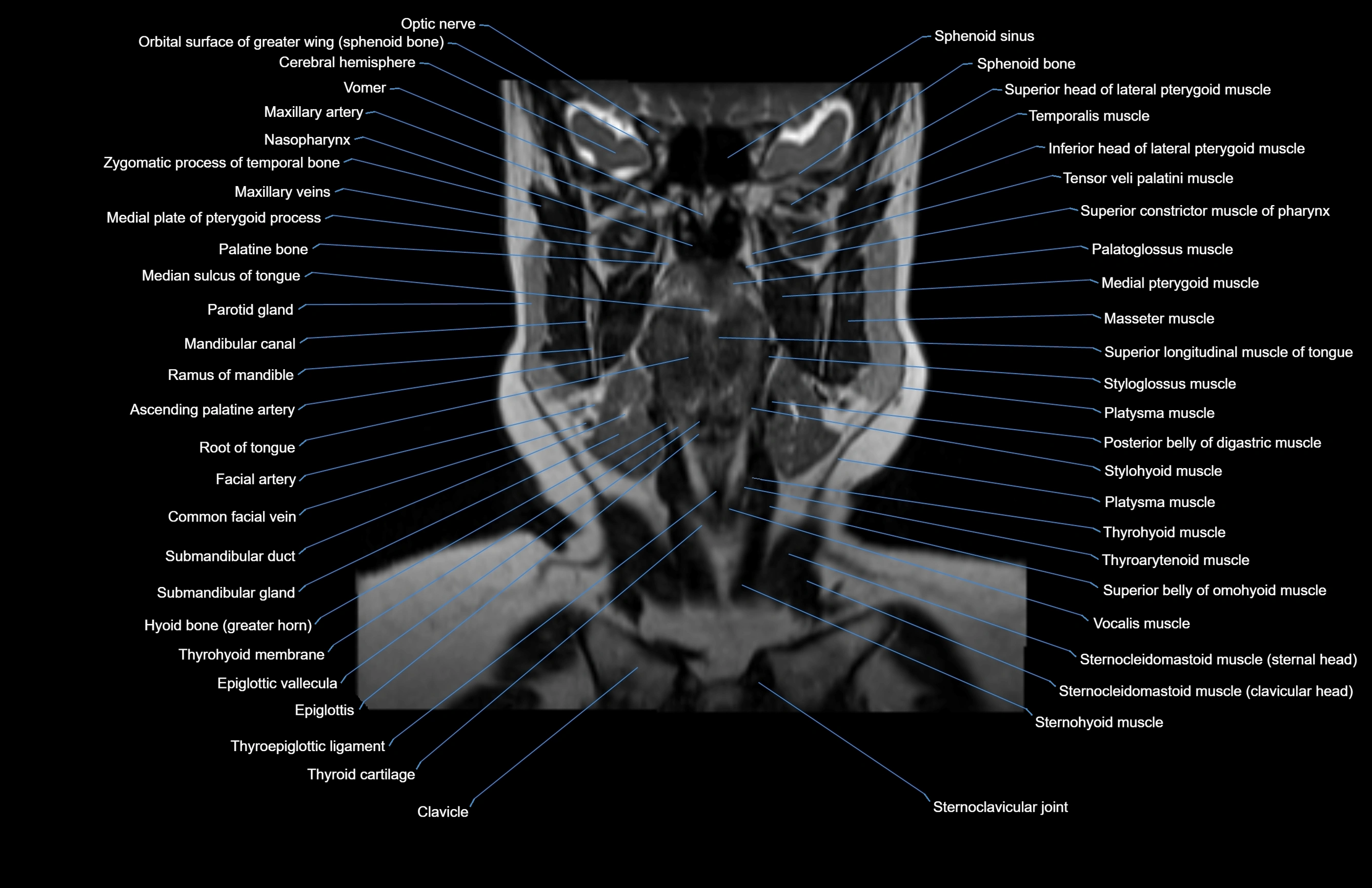 Neck coronal cross sectional MRI anatomy 3T MRI  image-img-00001-00048.webp